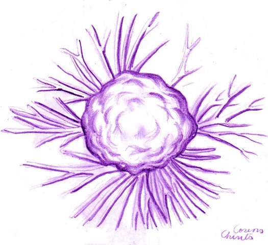Celula canceroasa - Cancer cell