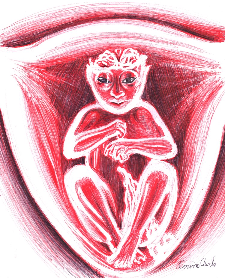 fetus cu anencefalie - Baby with anencephaly